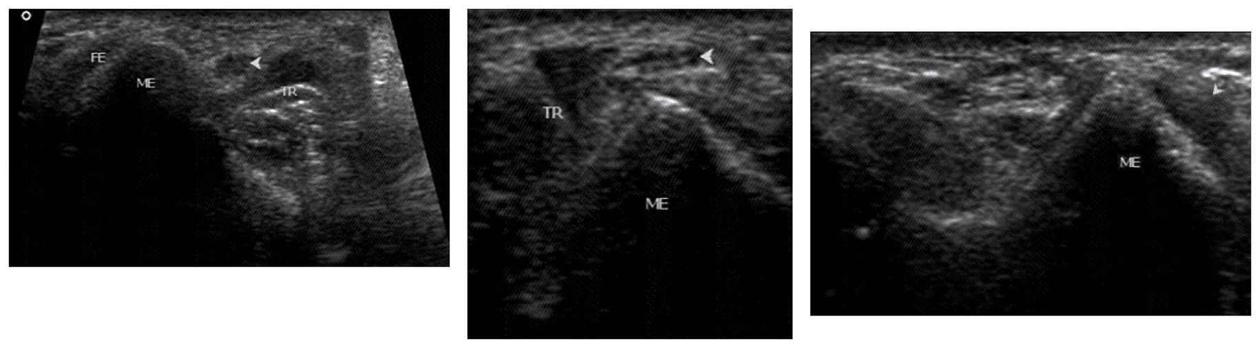 Three-panel dynamic ultrasound sequence showing ulnar nerve and medial triceps dislocation over the medial epicondyle during elbow flexion