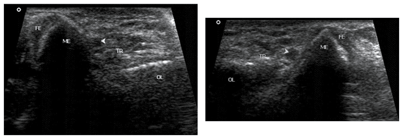 Two-panel normal dynamic ultrasound showing stable ulnar nerve and medial triceps behind the medial epicondyle in extension and flexion