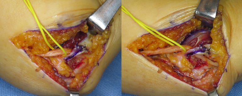 Paired medial elbow operative views showing the ulnar nerve after submuscular anterior transposition