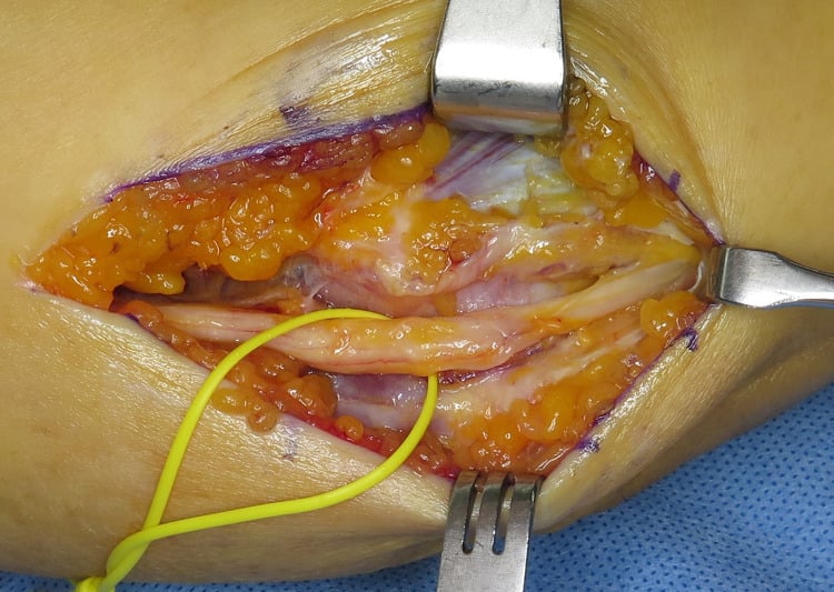 Tightly framed medial elbow operative field showing the decompressed ulnar nerve protected by a yellow vessel loop