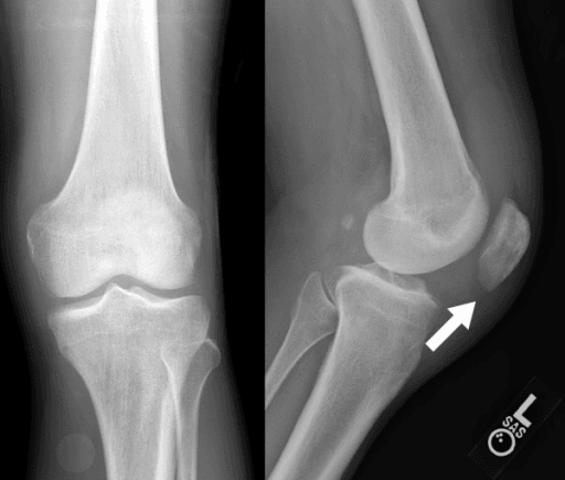 AP and lateral knee radiographs with an arrow marking lucency in the inferomedial patella and a joint effusion.