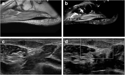 MRI images showing dark fusiform thickening of the distal plantar fascia with corresponding ultrasound image.