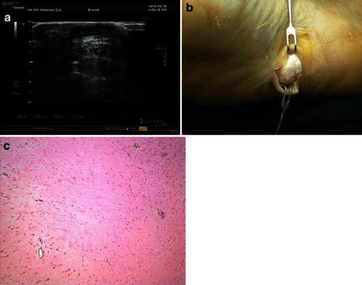 Ultrasound image of a plantar soft-tissue lesion alongside intra-operative photograph of a lobulated tumour above the plantar fascia.