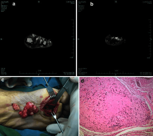 T1- and T2-weighted MRI images of the sole showing a dark mass in the distal plantar region.