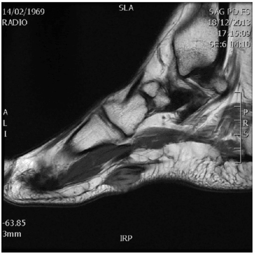 Sagittal T1-weighted MRI of the foot with a dark nodular mass in the distal plantar fascia.