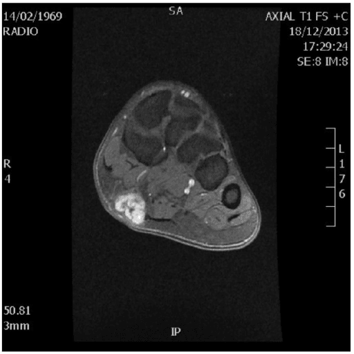 Axial T1-weighted contrast-enhanced MRI of the foot showing an enhancing nodule in the medial plantar fascia.