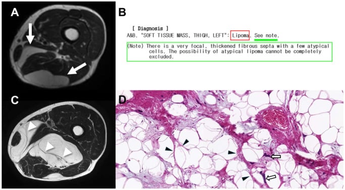 Serial MRI and histology of an atypical lipomatous tumour initially interpreted as lipoma