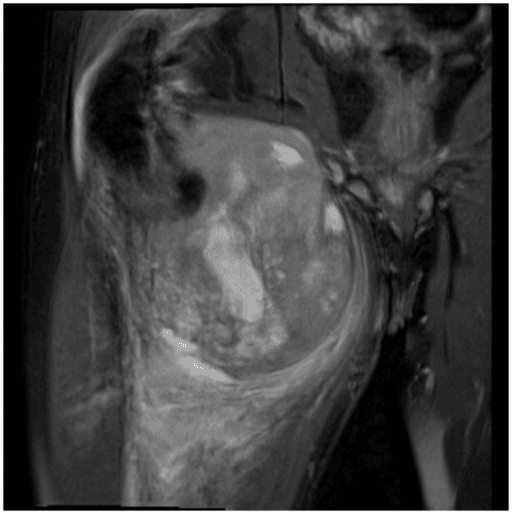 Deep thigh soft tissue sarcoma MRI