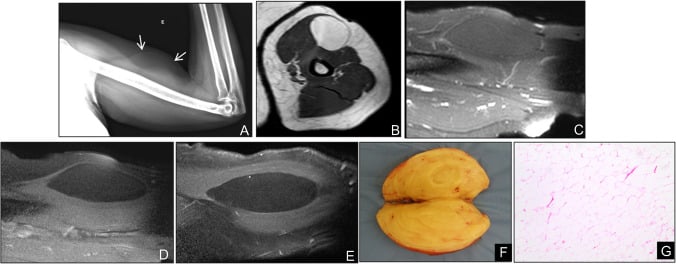 Radiograph, MRI, ultrasound, specimen and histology of a homogeneous intramuscular lipoma
