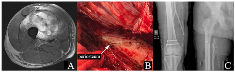 MRI, operative periosteal stripping and later femoral fracture radiographs after sarcoma radiotherapy