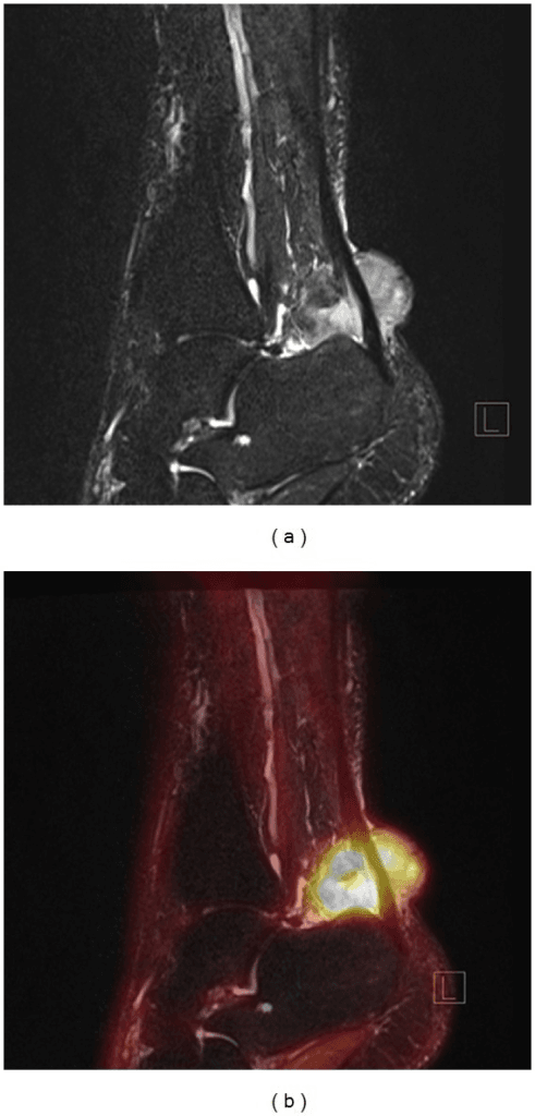 PET MRI clear cell sarcoma ankle