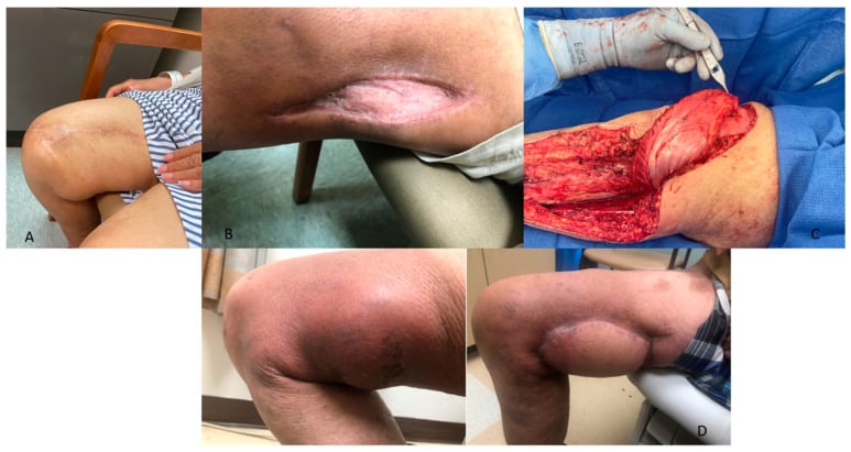 Clinical examples of local rearrangement, skin graft, rotational flap and free flap after sarcoma resection