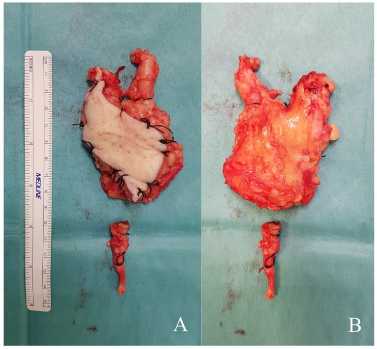 Superficial and deep surfaces of a sarcoma specimen resected with fascia and a muscle cuff
