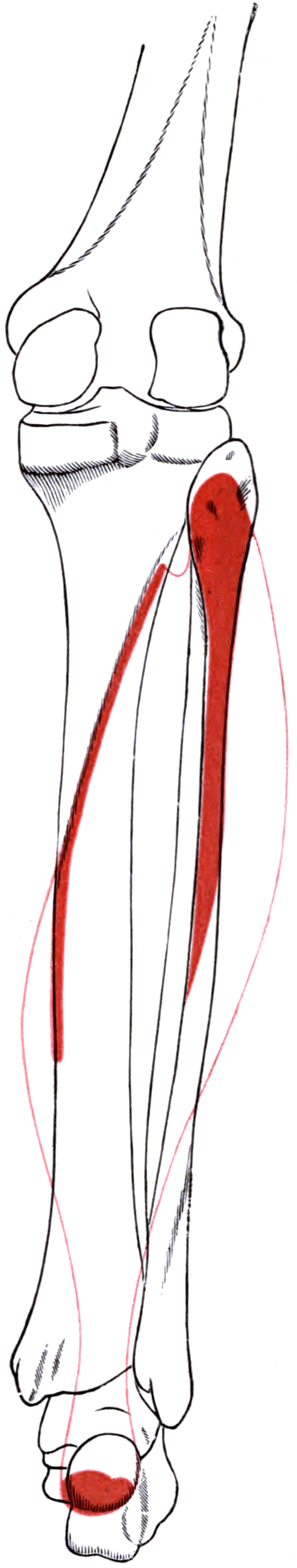 Posterior view of the right soleus muscle with outline and attachment areas indicated.