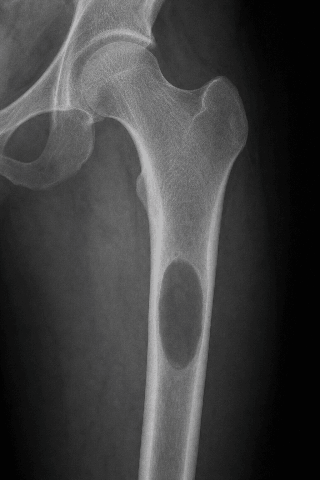 Plain radiograph showing a single well-defined lytic lesion in the proximal femur