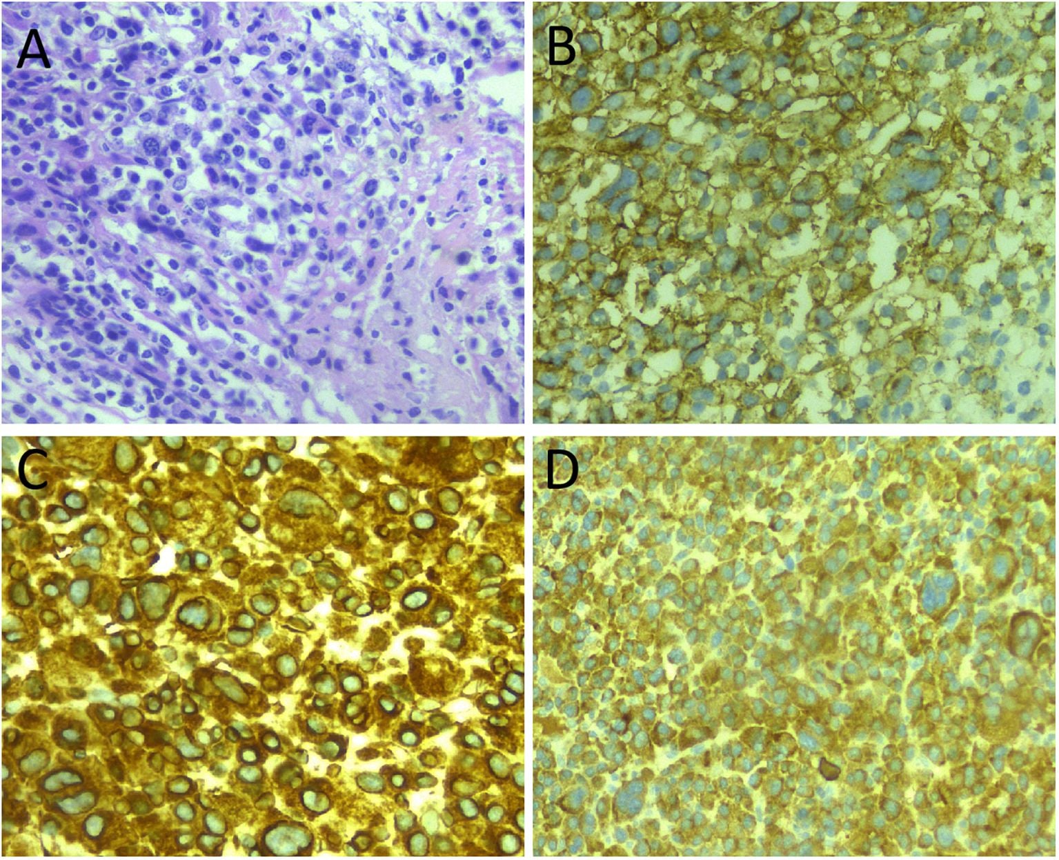Four-panel histology: H&E sheets of plasma cells and immunohistochemistry positive for CD138, kappa and MUM1.