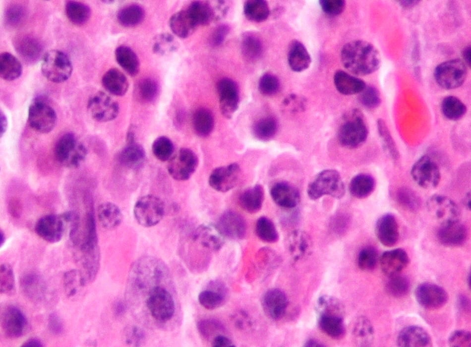 High-power H&E micrograph of a plasmacytoma showing sheets of neoplastic plasma cells