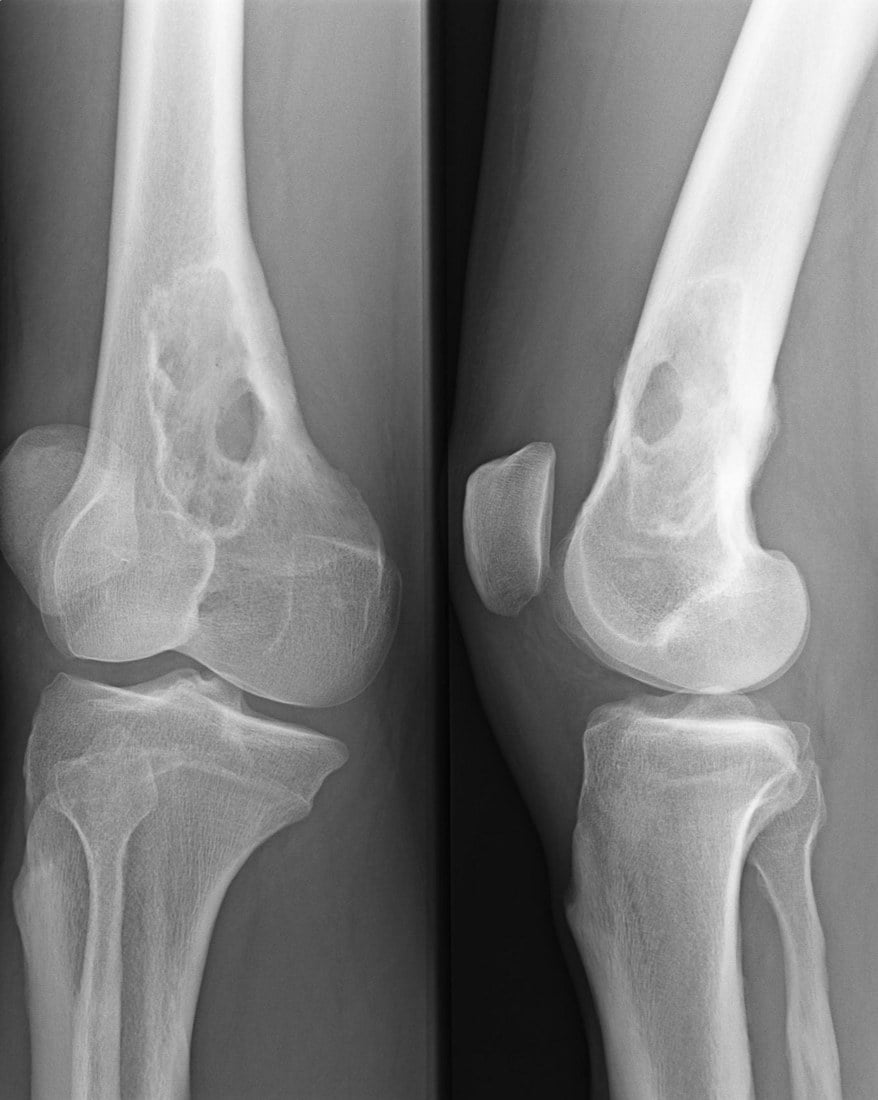 AP and lateral knee radiographs showing a well-defined lytic lesion in the lower third of the femur