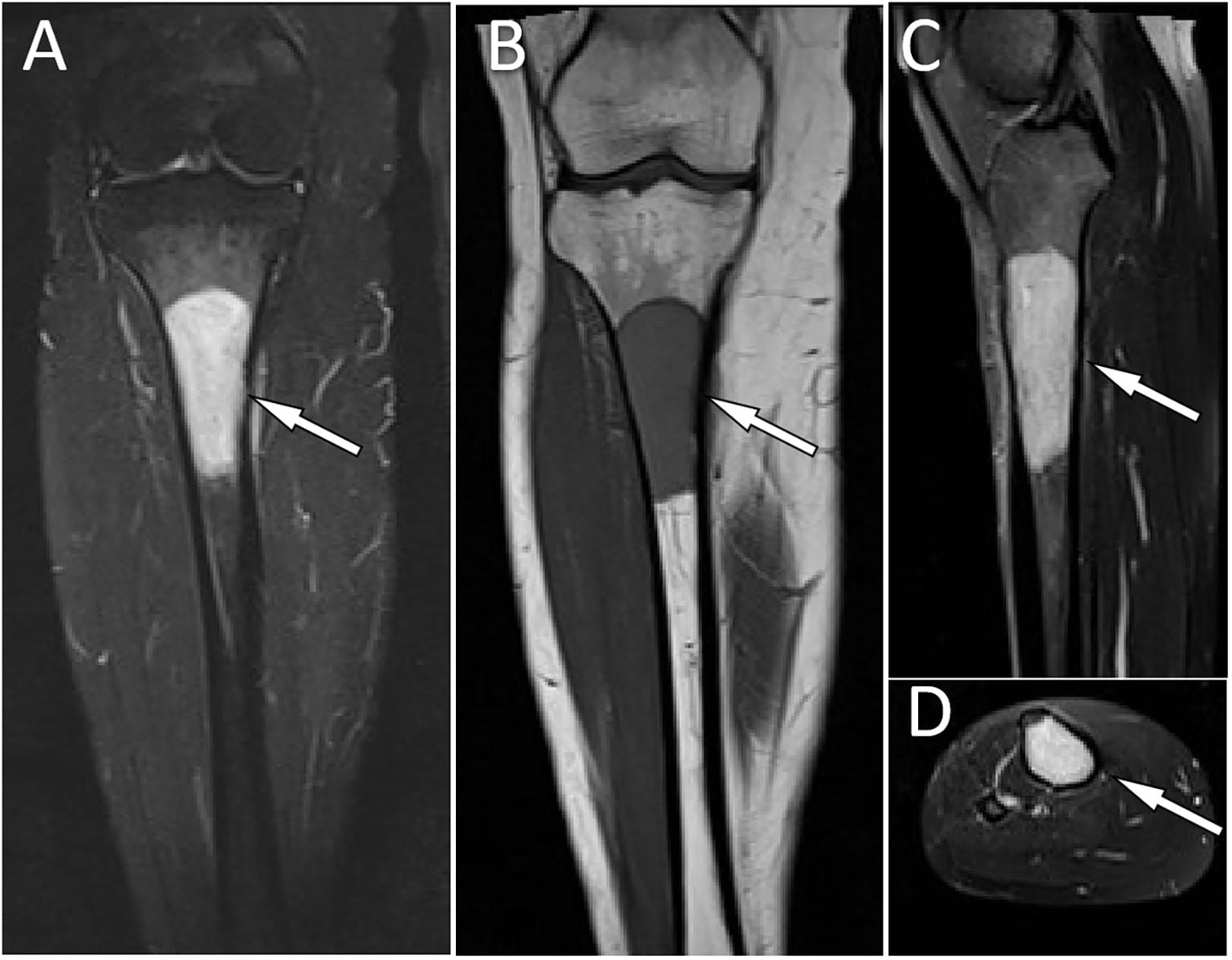 Four-panel MRI of a proximal tibial solitary plasmacytoma: T2-bright, T1-dark, homogeneously enhancing on coronal and axial post-contrast T1.