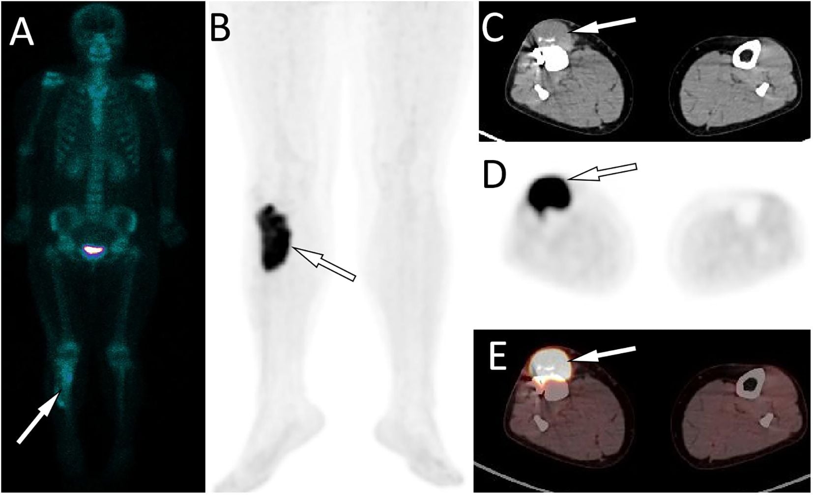 Whole-body SPECT showing solitary tibial uptake, then later PET-CT of local FDG-avid recurrence at the surgical bed.