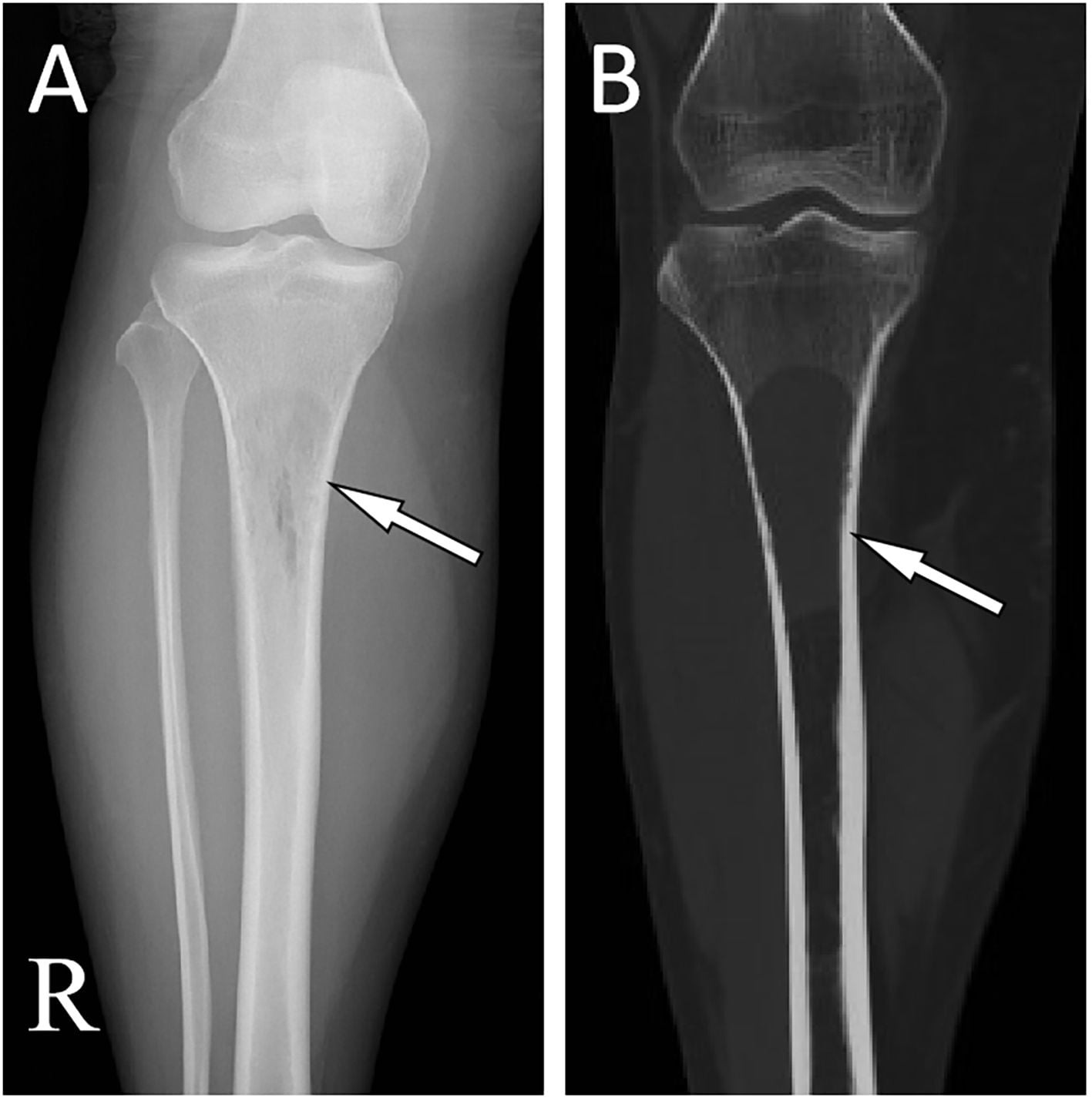 AP radiograph and axial CT of a proximal tibial solitary plasmacytoma: a longitudinal lucency without periosteal reaction or a sclerotic rim, cortex intact.