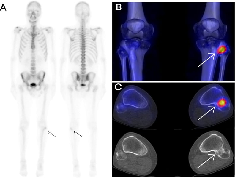 Whole-body bone scintigraphy, 3D SPECT-CT fusion and axial fused SPECT-CT localising uptake to a proximal tibiofibular synostosis.
