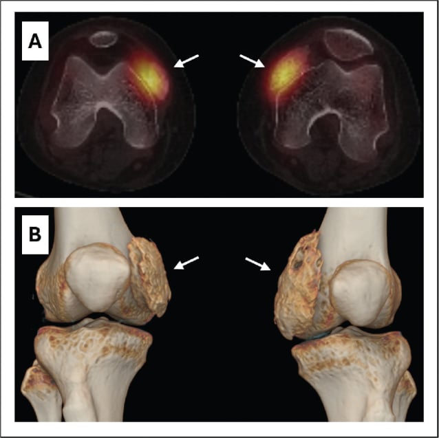 Axial fused knee SPECT-CT and 3D CT reconstructions showing metabolically active bilateral heterotopic ossification.