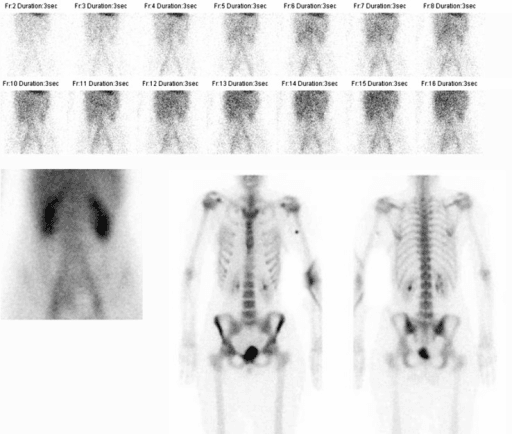 Three-phase planar bone scintigraphy: dynamic flow frames and whole-body delayed images