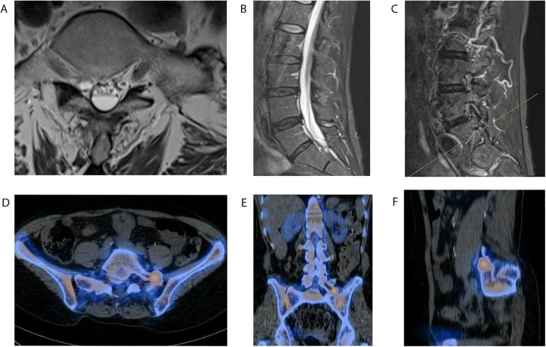 Lumbar MRI and fused SPECT-CT views of the lumbosacral transitional vertebra region in a patient without a clear compressive MRI lesion.