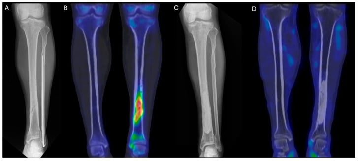 Preoperative and postoperative tibial radiographs and coronal bone SPECT-CT demonstrating resolution of focal metabolic activity after infection treatment.