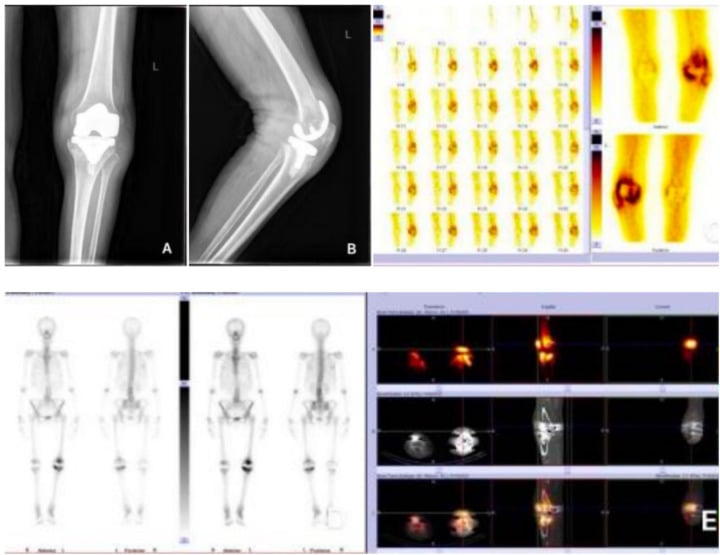 Painful total knee arthroplasty assessment with radiographs, dynamic and whole-body bone scintigraphy, and fused SPECT-CT.