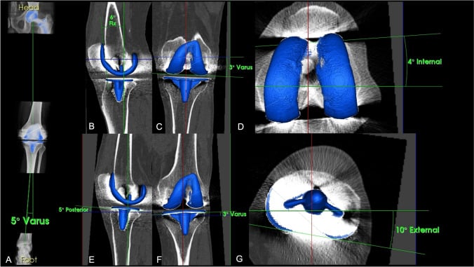 Three-dimensional SPECT-CT analysis of a painful total knee arthroplasty with femoral and tibial component alignment measurements and mapped tracer activity.