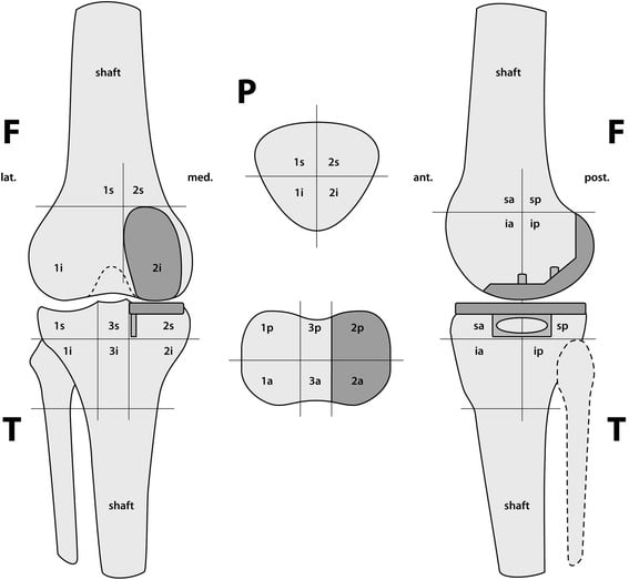 Diagram dividing femur, tibia and patella into reproducible regions for reporting tracer activity after unicompartmental knee arthroplasty.