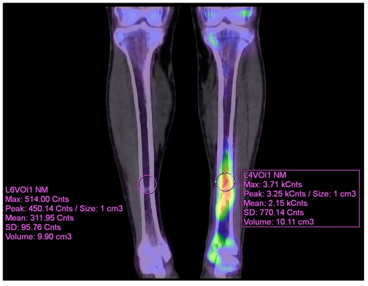 Coronal quantitative bone SPECT-CT with matched volumes of interest over affected and contralateral lower legs.