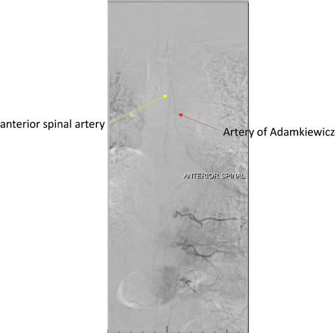 Digital subtraction angiogram of the artery of Adamkiewicz injected from the left T8 radicular artery