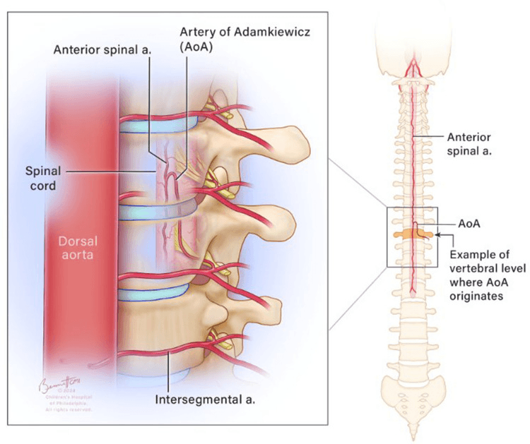Schematic of the artery of Adamkiewicz entering through the intervertebral foramen and taking its hairpin turn to reach the anterior spinal artery