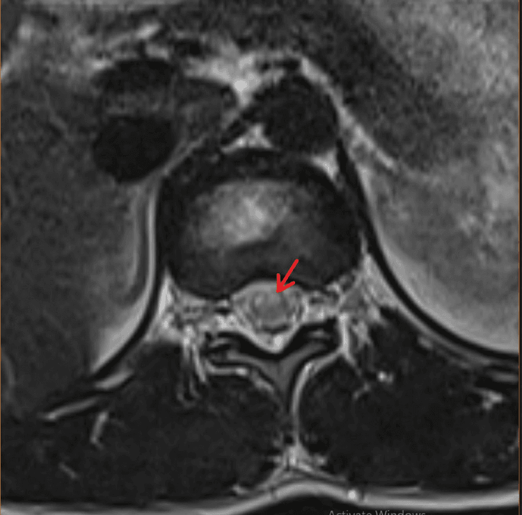 Axial T2 MRI of the dorsal cord showing bilateral anterior horn hyperintensity in the owl’s eyes pattern of anterior spinal artery infarction