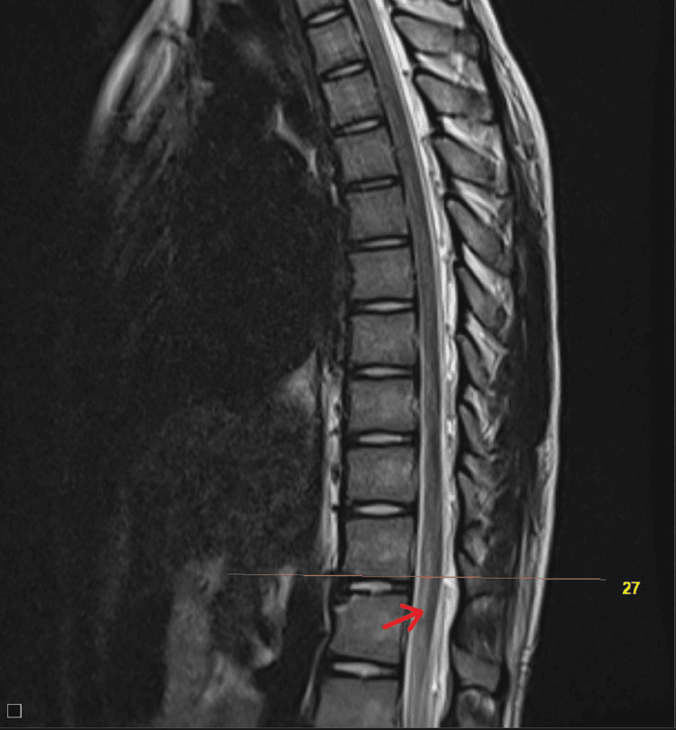 Sagittal T2 MRI showing longitudinal ventral cord hyperintensity in anterior spinal artery syndrome
