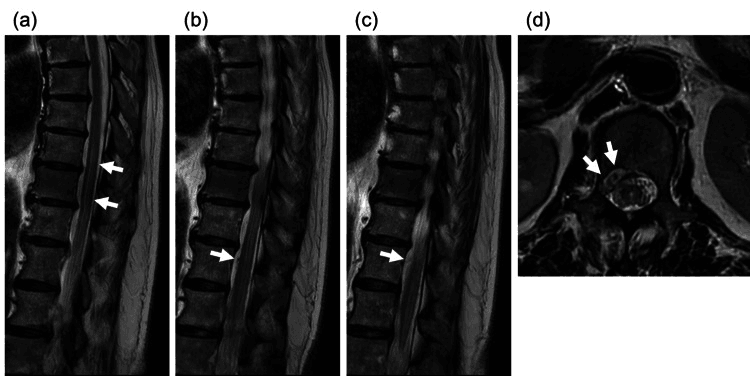 Sagittal T2 MRI showing long-segment intramedullary hyperintensity from venous congestion with serpiginous perimedullary flow voids in a spinal epidural arteriovenous fistula