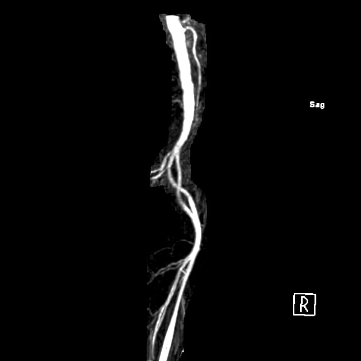MR angiogram showing the artery of Adamkiewicz making a hairpin turn to join the anterior spinal artery