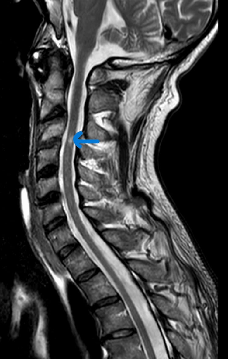 Sagittal T2 MRI four months after cervical epidural abscess treatment showing resolved collections but residual cord T2 hyperintensity