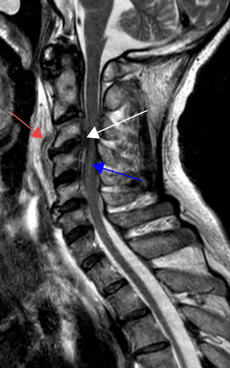 Sagittal T2 MRI of the cervical spine showing C3-C4 spondylodiscitis, a large prevertebral abscess and anterior epidural compression of the cord