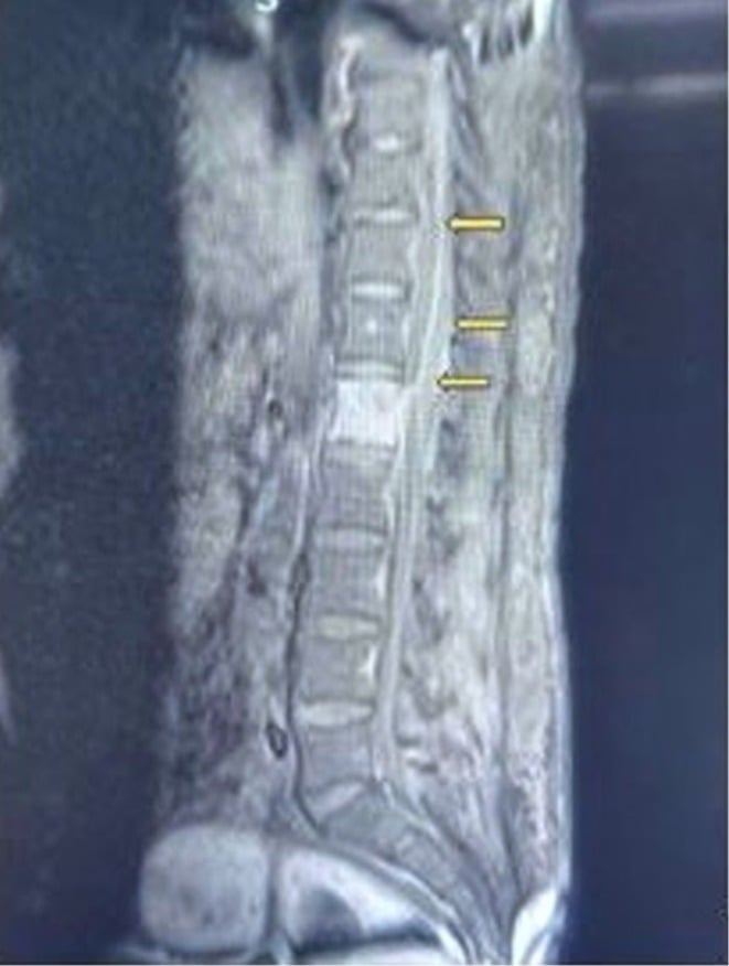 Sagittal post-contrast T1 MRI of a long-segment dorsolumbar epidural abscess from D9 to L2