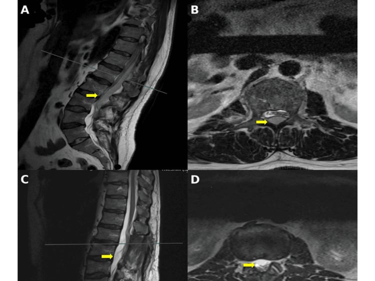 Preoperative sagittal and axial MRI of a multi-level posterior spinal epidural abscess compressing the cord, then postoperative MRI after single-level decompression