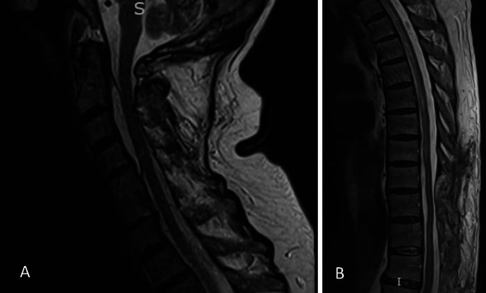Postoperative sagittal T2 MRI of the cervical and thoracolumbar spine after limited decompression of spinal epidural abscesses