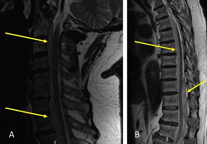 Preoperative sagittal T2 MRI of cervical and thoracolumbar spinal epidural abscesses
