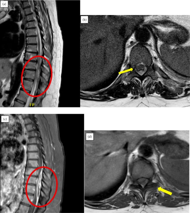 Sagittal and axial T2 and post-contrast T1 MRI of a dorsal thoracic epidural abscess from T8 to T11 with thecal-sac effacement and rim enhancement