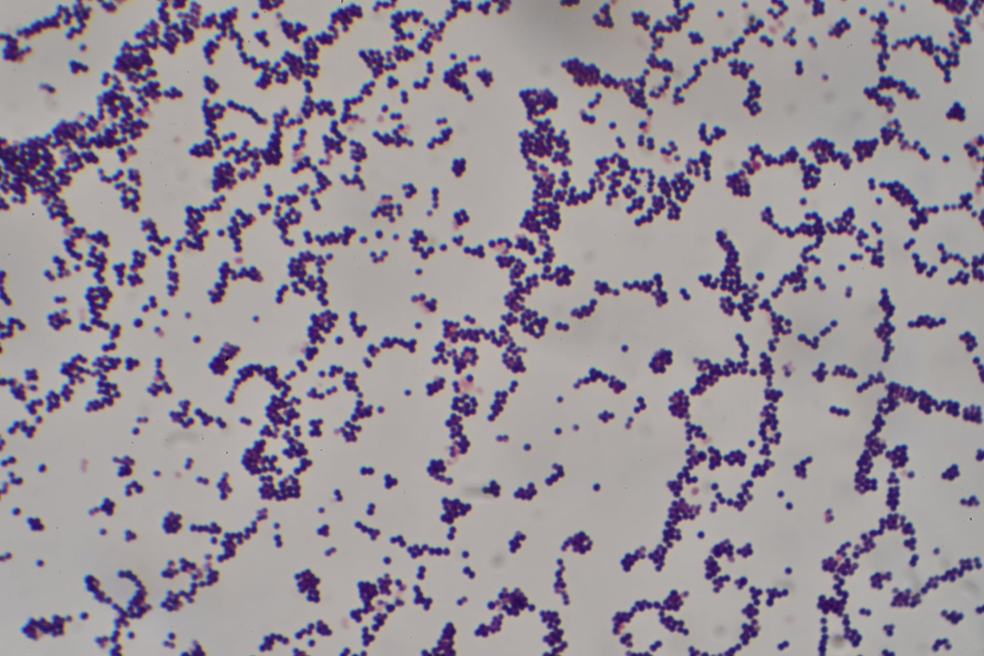 Gram stain of Staphylococcus aureus β Gram-positive cocci in clusters. S. aureus is the dominant pathogen in spinal epidural abscess (roughly two-thirds of cases).