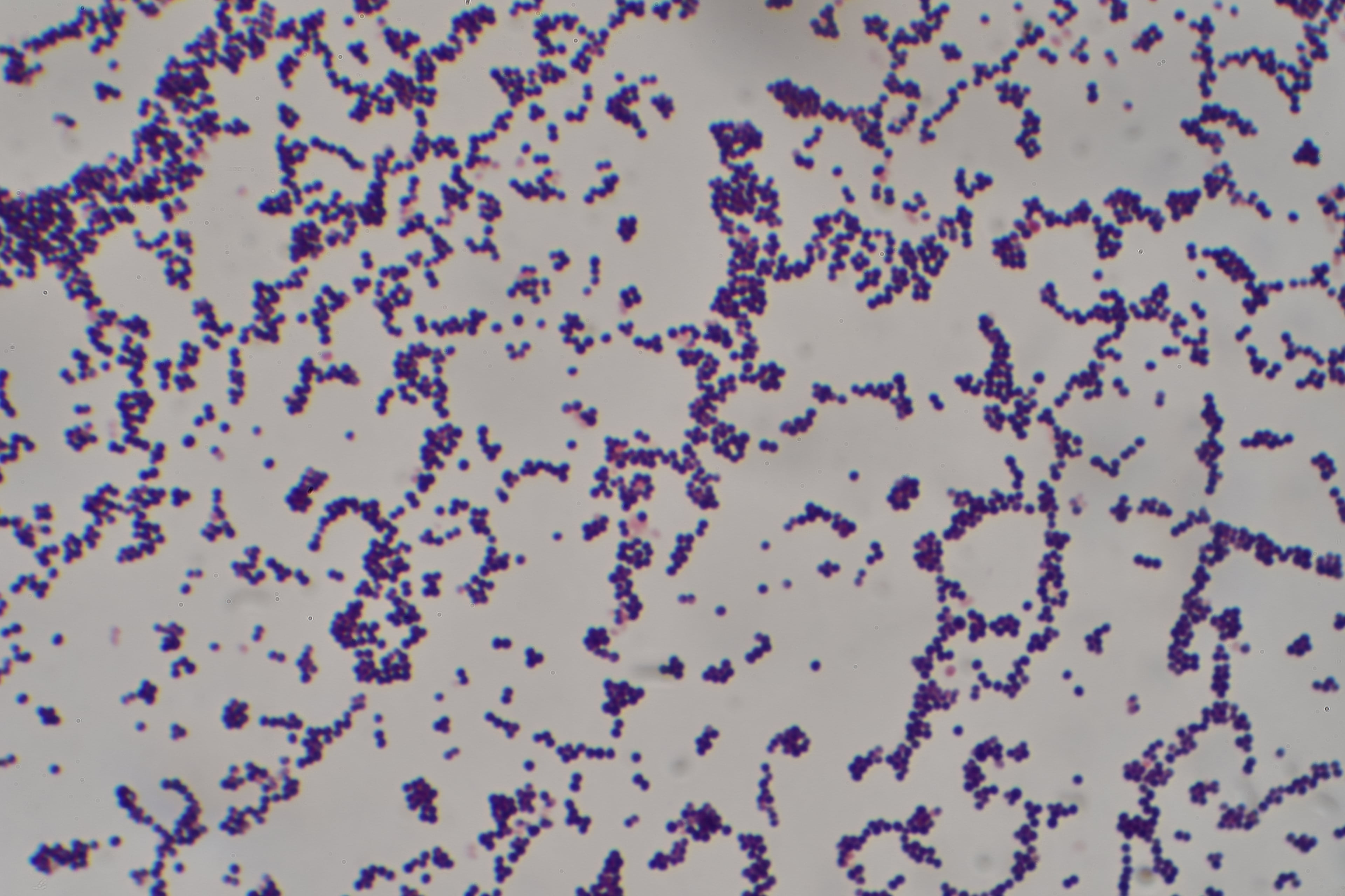 Gram stain showing Gram-positive cocci in grape-like clusters typical of Staphylococcus aureus