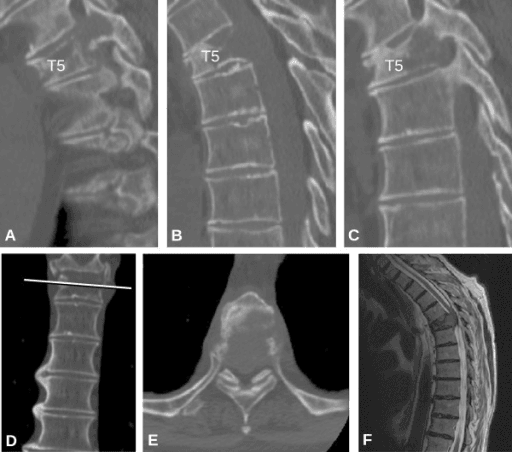 CT and MRI of a thoracic T5 vertebral metastasis shown in multiple planes.